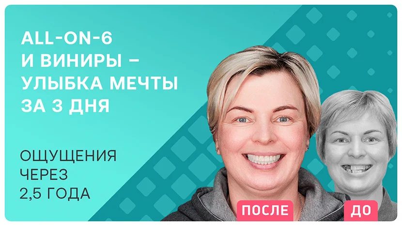 Видео-отзыв после имплантации зубов all-on-6 и установки виниров
