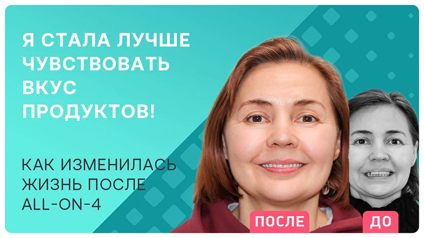 Видео отзыв после имплантации зубов методом All-on-4