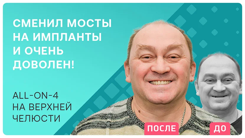 Видео отзыв после имплантации All-on-4 вместо старых зубных мостов