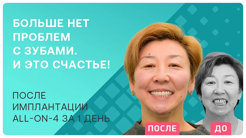 Видео отзыв после имплантации зубов all-on-4 за 1 день