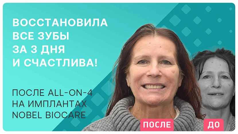 Видео отзыв после имплантации зубов методом All-on-4