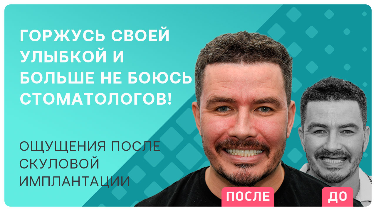 Видео отзыв после скуловой имплантации Nobel Zygoma