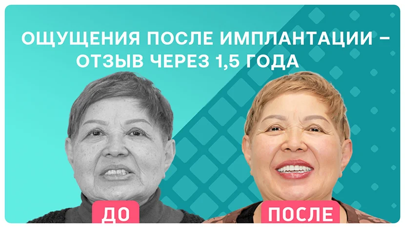 Видео-отзыв через полтора года после имплантации