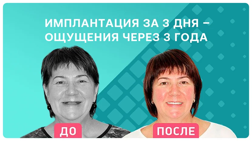 Видео-отзыв после имплантации всех зубов