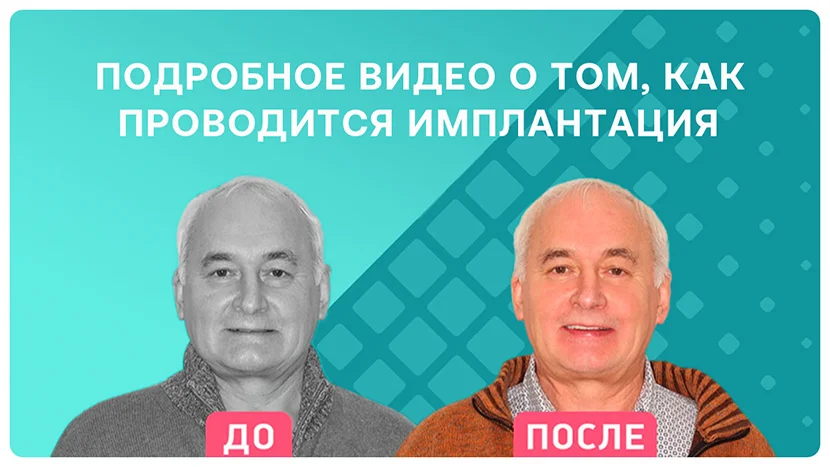 Видео-отзыв как проводится комплексная имплантация
