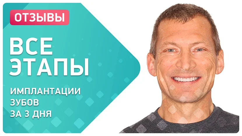 Видео-отзыв пациента о проведении комплексной имплантации зубов верхней челюсти