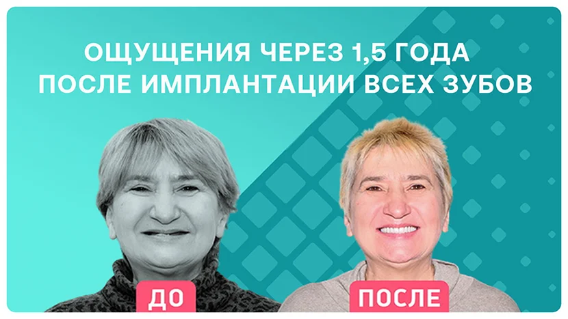 Видео-отзыв  через полтора года после имплантации зубов