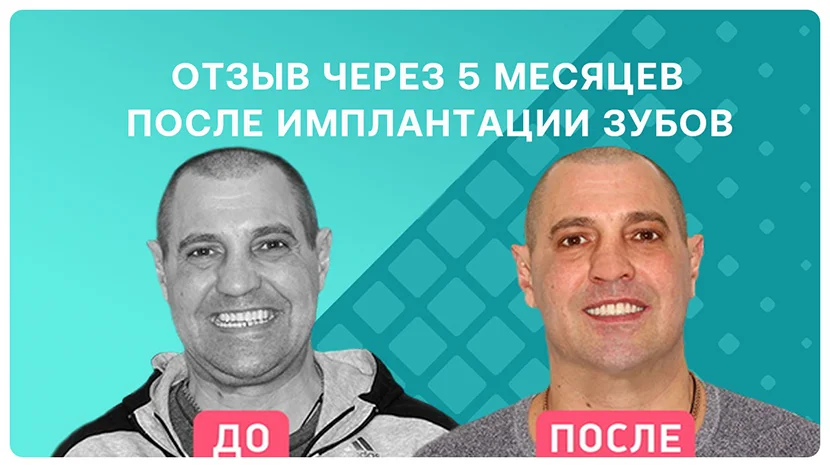 Видео-отзыв через 5 месяцев после безальной имплантации