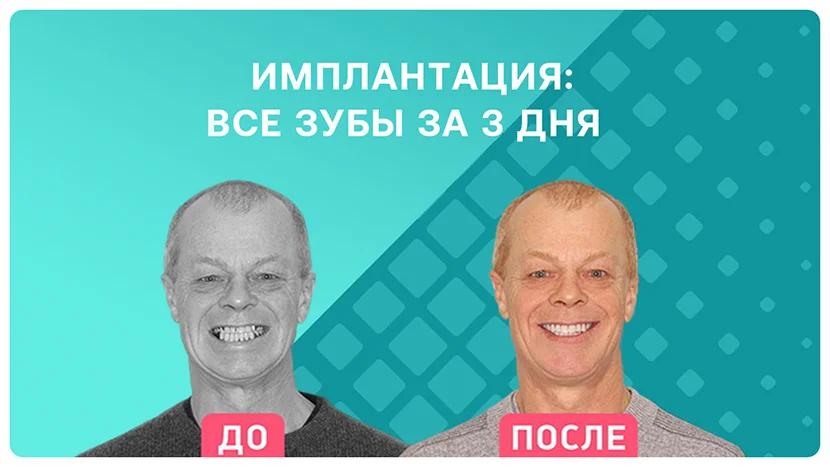 Видео-отзыв сразу после операции по имплантации зубов