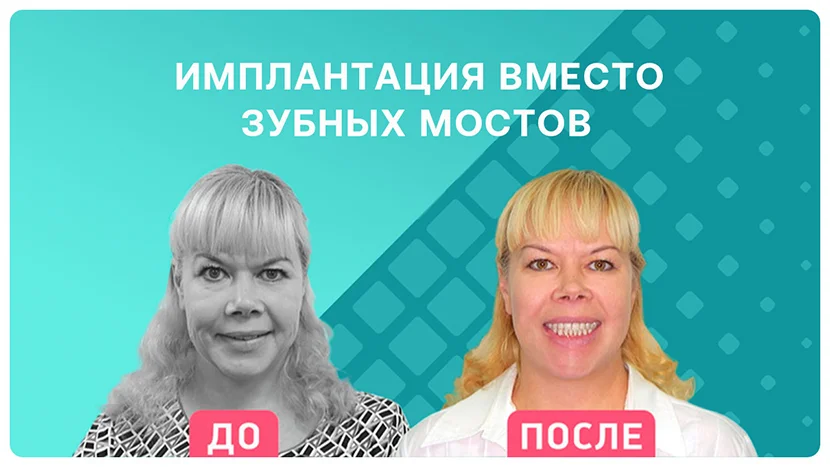 Видео-отзыв после моментальное восстановление зубов