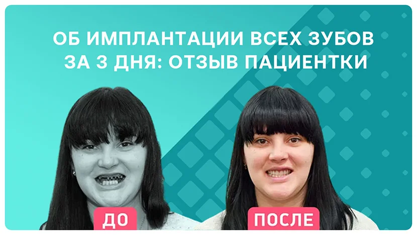 Видео-отзыв через 1,5 года после имплантации