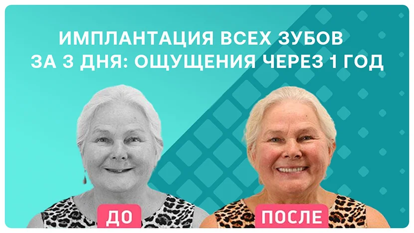 Видео-отзыв через год после комплексной имплантации зубов