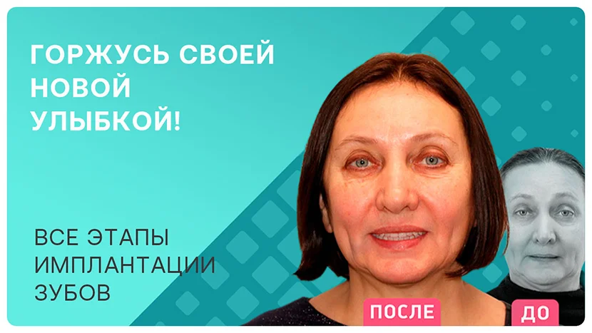 Видео-отзыв этапы комплексной имплантации видео
