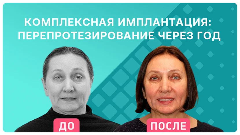 Видео-отзыв перепротезирование через 1 год