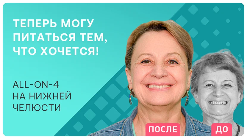Видео отзыв после имплантации зубов all-on-4 на нижней челюсти 