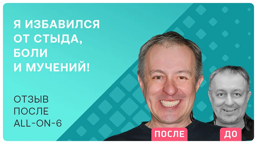 Видео-отзыв про имплантацию all-on-6