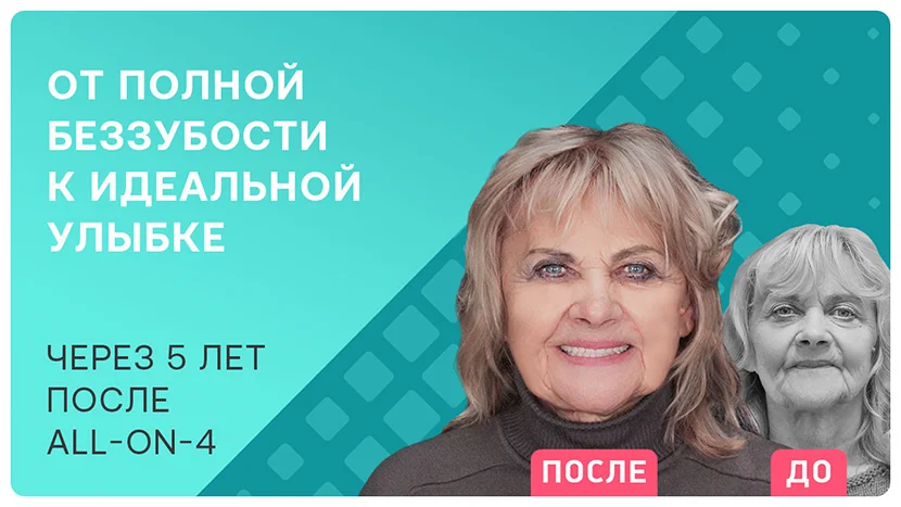 Видео-отзыв через 5 лет после имплантации зубов