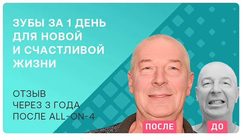 Видео-отзыв после имплантации всех зубов all-on-4 на обеих челюстях