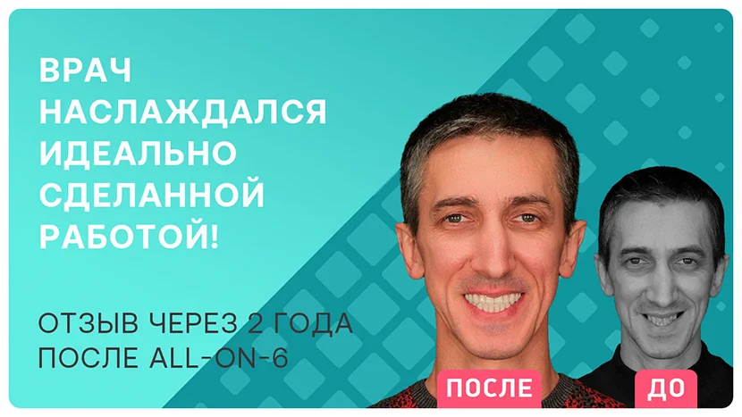 Видео-отзыв через 2 года после имплантации all-on-5