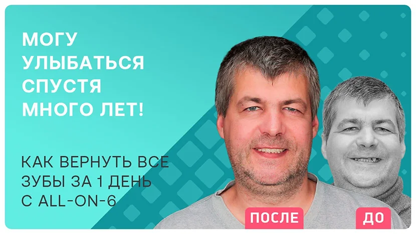 Видео отзыв после имплантации All-on-6 за 1 день