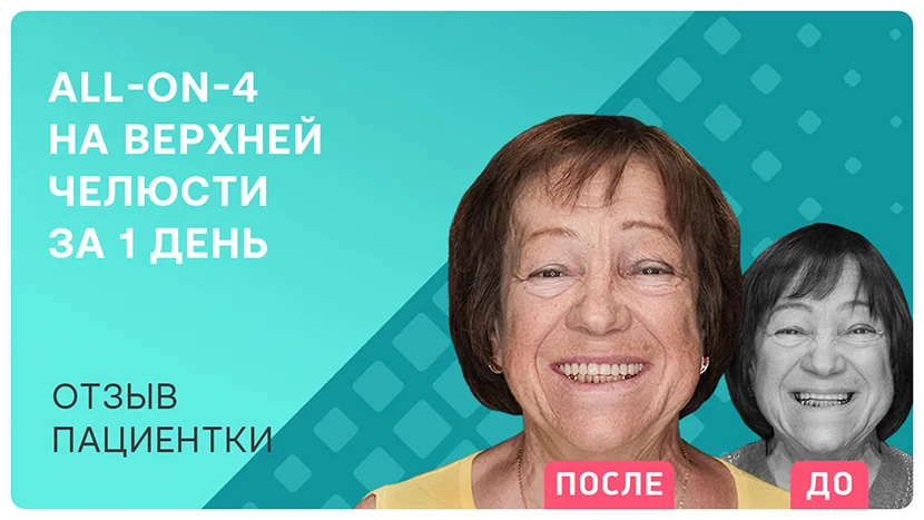 Видео-отзыв после имплантации всех зубов на верхней челюсти за 1 день