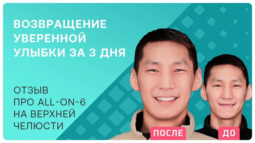 Видео-отзыв после имплантации методом All-on-4 на верхней челюсти