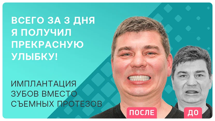 Видео отзыв о скуловой имплантации зубов All-on-4 Nobel Zygoma