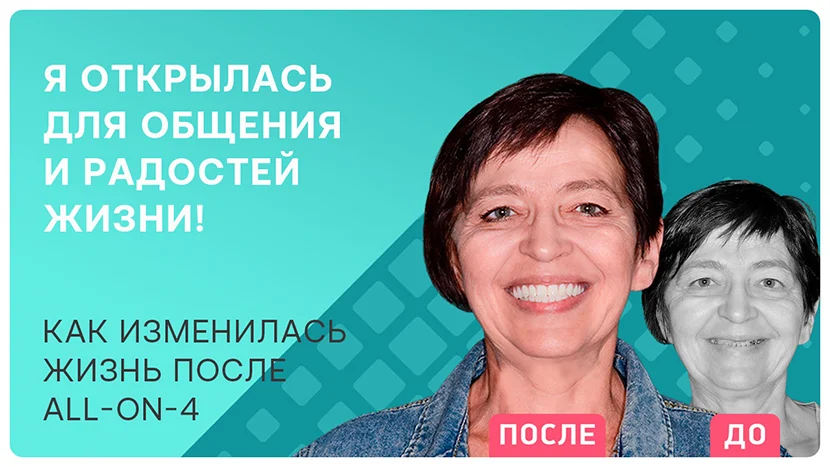 Видео-отзыв подробно об имплантации зубов all-on=4