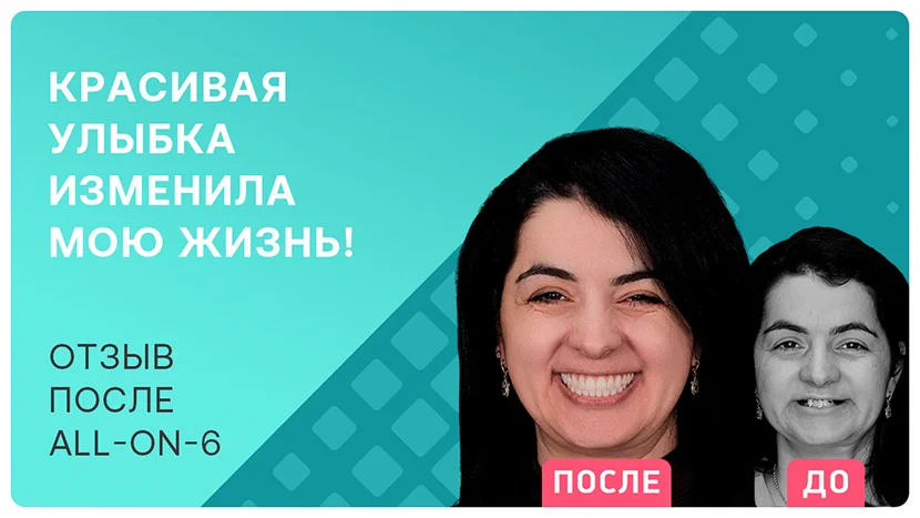 Видео-отзыв после имплантации всех зубов all-on-6 молодой пациентки