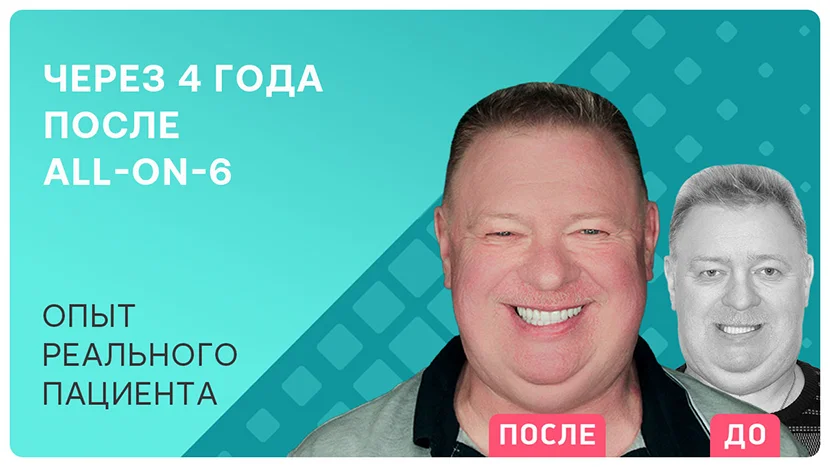 Видео-отзыв об имплантации all-on-6 через 4 года