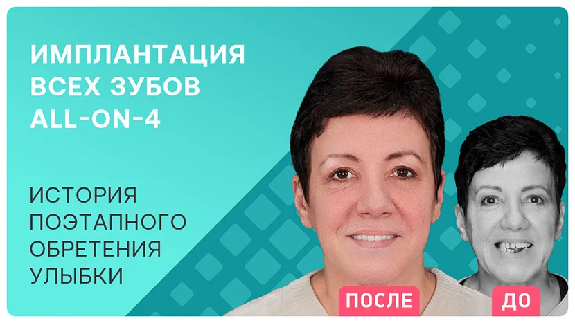 Видео-отзыв история поэтапного восстановления улыбки