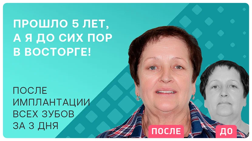Видео-отзыв через 5 лет после имплантации зубов