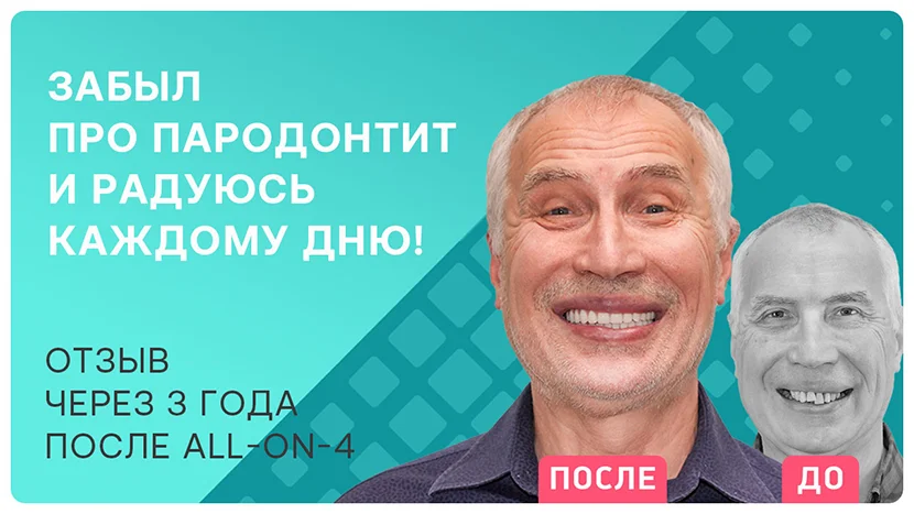 Видео-отзыв после имплантации зубов при пародонтите