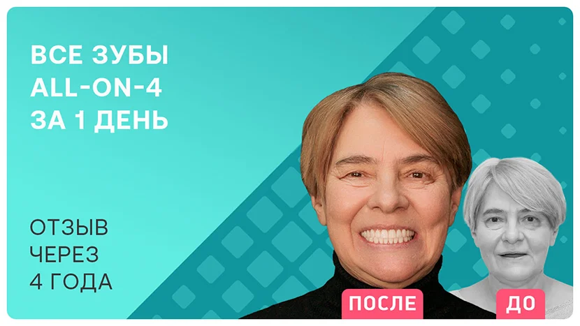 Видео отзыв: полный отзыв через 4 года после имплантации