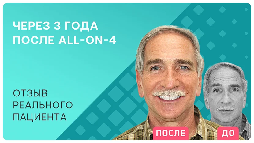 Видео отзыв через 3 года после имплантации all-on-4