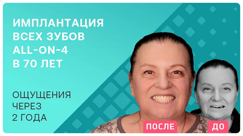 Видео-отзыв через 2 года после имплантации зубов в 74 года
