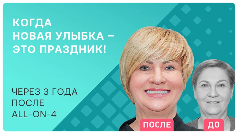 Отзыв пациентки через 3 года после имплантации all-on-4