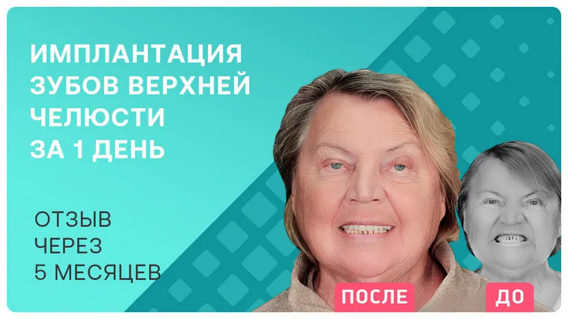 Видео-отзыв после имплантации всех зубов за 1 день