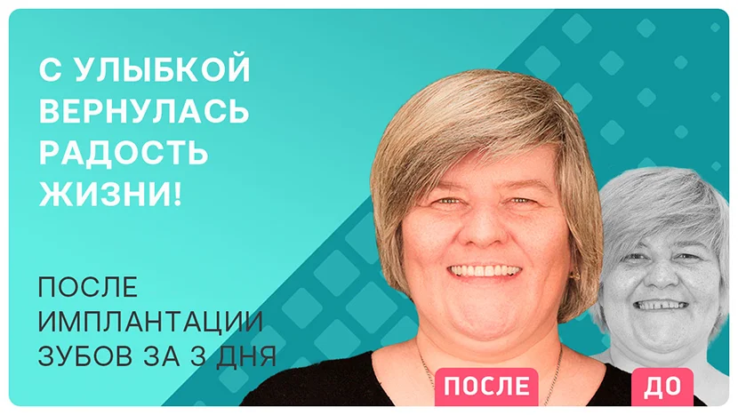 Видео отзыв через 2 года после имплантации All-on-4 Nobel Biocare