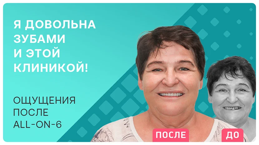 Видео-отзыв после установки имплантов all-on-6