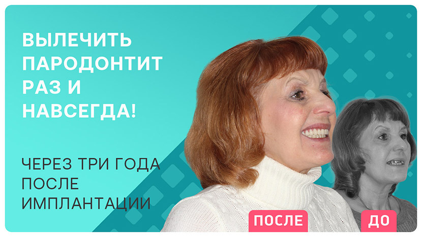 Через 3 года после имплантации зубов