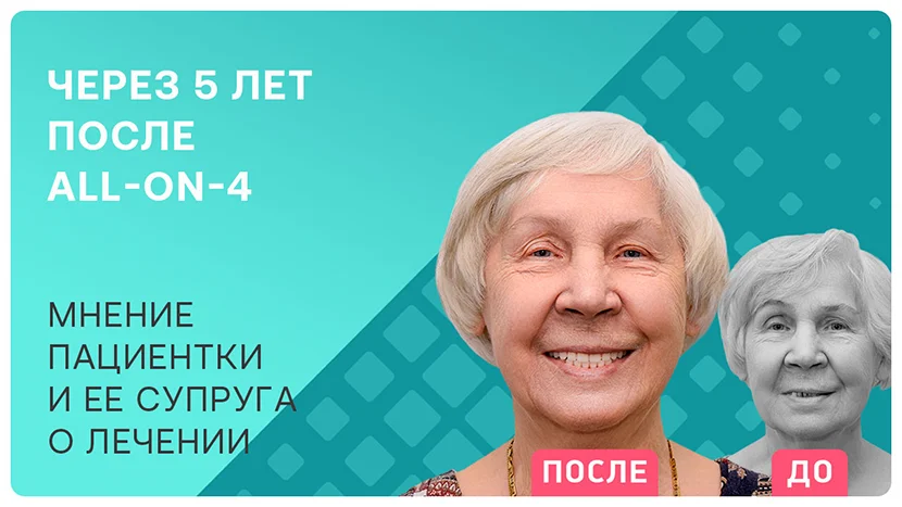 Видео-отзыв через 5 лет после имплантации зубов в 86 лет