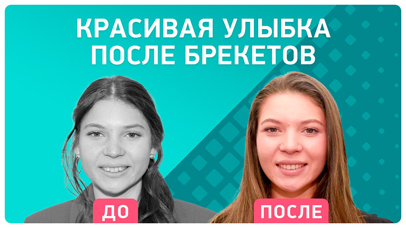 Видео отзыв после снятия брекетов