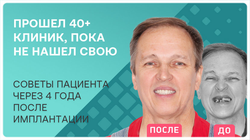Видео отзыв: советы через 4 года после имплантации
