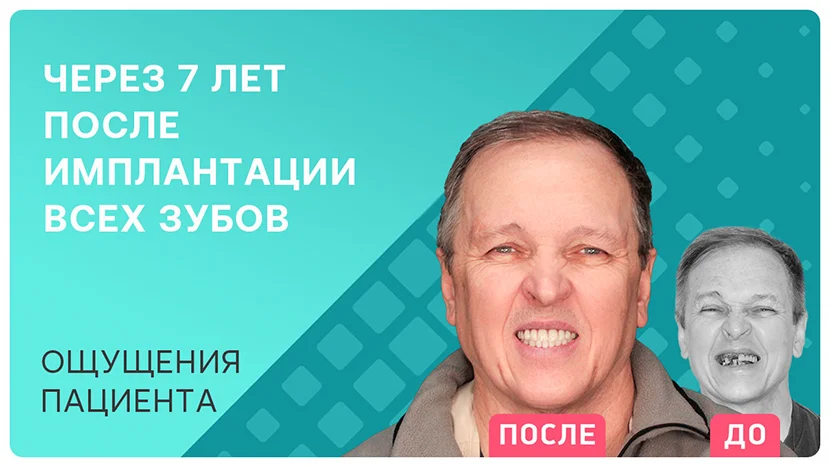 Видео отзыв: полный отзыв через 7 лет после имплантации