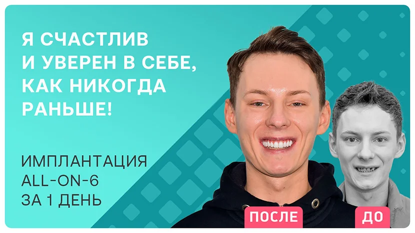 Видео отзыв через 7 месяцев после комплексной имплантации Straumann ProArch