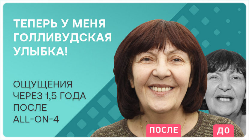 Видео отзыв через полтора года после имплантации зубов