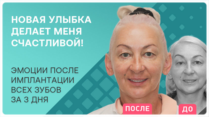 Видео отзыв после проведения имплантации зубов за 3 дня
