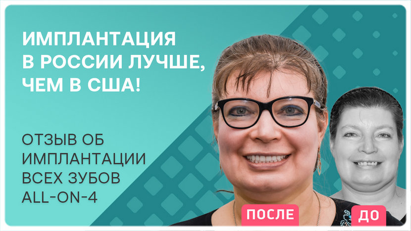 Видео после проведения имплантации зубов All-on-4