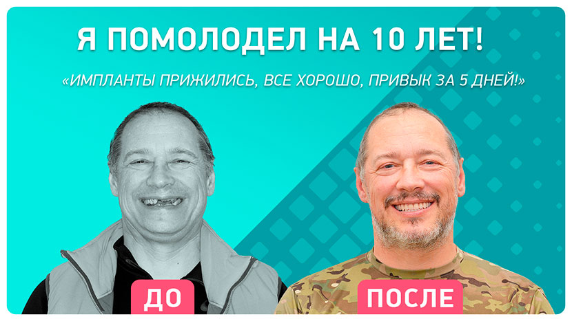 Видео-отзыв после имплантации